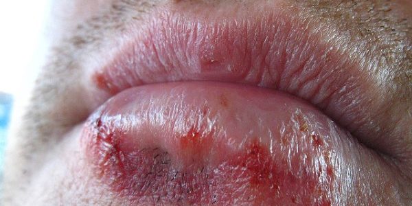 Hausmittel gegen Herpes